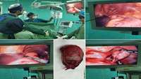 Two simultaneous operations with laparoscopic method in Kosar Hospital, Semnan