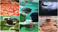 Successful surgery to remove a brain tumor with the help of an ultrasound device in Kosar Hospital