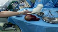Splenectomy of a 1.5 kg spleen from a 16-year-old patient in Kosar Hospital