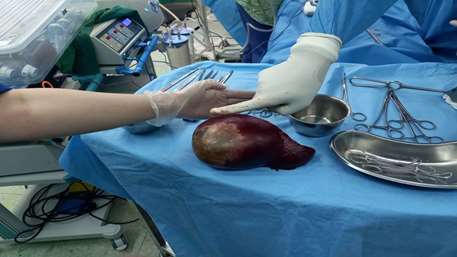 Splenectomy of a 1.5 kg spleen from a 16-year-old patient in Kosar Hospital